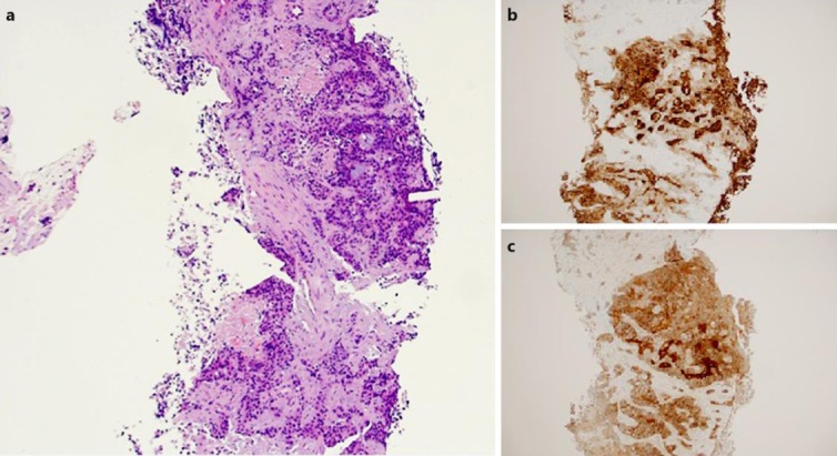 Hepatoid Adenocarcinoma Of The Duodenum: An Unusual Location - Pmc