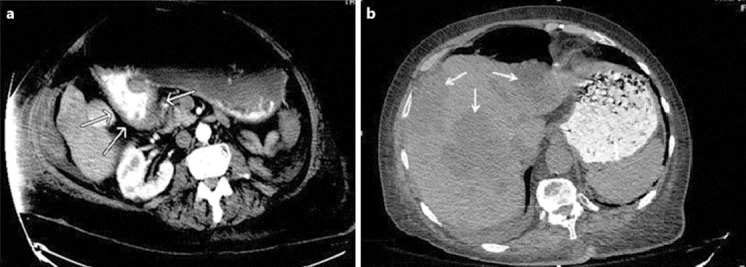 Hepatoid Adenocarcinoma Of The Duodenum: An Unusual Location - Pmc