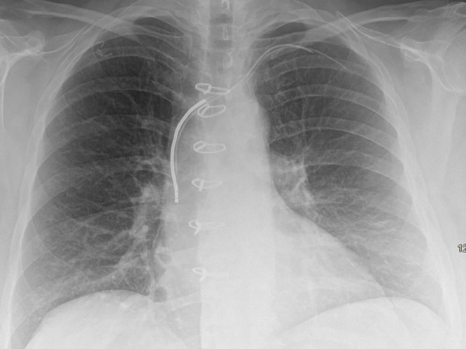 Chest radiograph, posteroanterior view, in an 85-year-old woman with history of previous pacemaker that was explanted and retained right ventricular pacing lead. There is evidence of vertebroplasties at multiple levels.