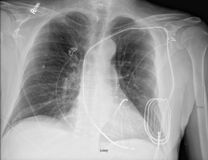 Chest radiograph, anteroposterior view, in a 76-year-old man with history of previous abdominal cardiac resynchronization therapy defibrillator that was explanted, with retained right ventricular defibrillator lead, coronary sinus lead, and an epicardial patch.