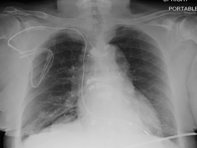 Chest radiograph, posteroanterior view, in a 64-year-old woman with history of heart transplantation, demonstrates retained portion of right ventricular pacing lead and defibrillator lead with superior vena cava coil. This patient underwent five MRI examinations as part of this registry.