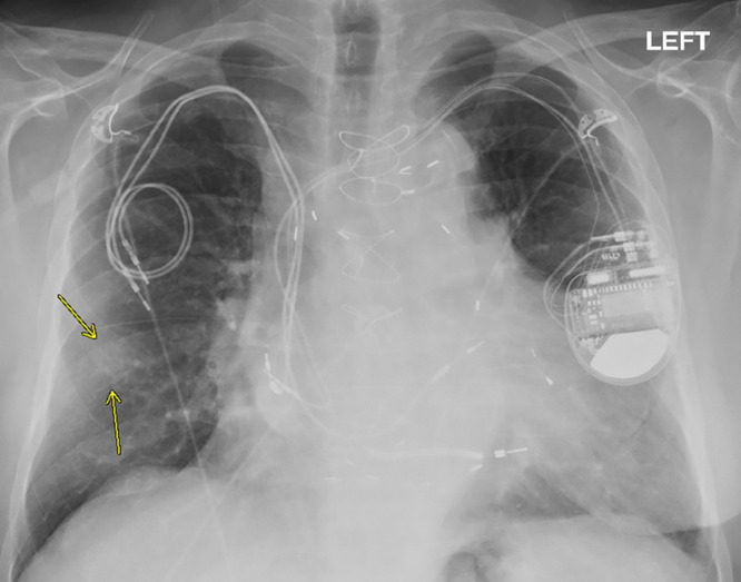 Chest radiograph, posteroanterior view, in a 79-year-old man with history of previous pacemaker, with abandoned right atrial and right ventricular pacing leads on the right side at time of new cardiac resynchronization therapy defibrillator implant on the left side. Arrows indicate a nodular opacity in the right midlung concerning for mass.