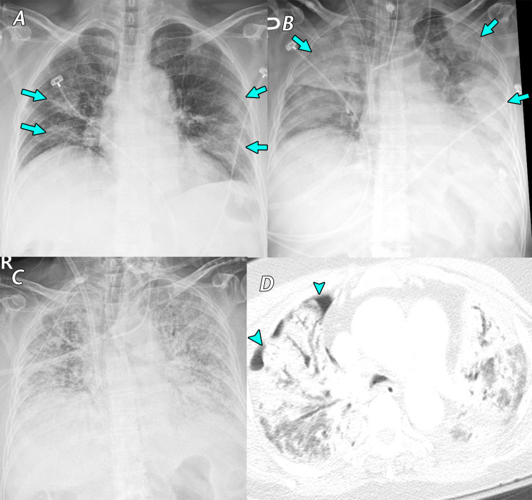 Fever, cough, sputum production, and anorexia for 1 week in a 77-year-old woman with asthma, which was managed daily with a long-acting β-agonist salmeterol and corticosteroid inhaler, who presented to a SARS-CoV-2 screening clinic. The test results confirmed SARS-CoV-2 infection, and the patient was transferred to a containment zone at our hospital. A, Anteroposterior chest radiograph obtained 14 days after symptom onset shows bilateral ill-defined ground-glass opacity and consolidation (arrows). B, C, Anteroposterior chest radiograph, B, obtained 19 days after symptom onset shows an increase in the extent of consolidation (arrows) after the patient’s symptoms worsened. Despite the use of extracorporeal membrane oxygenation (ECMO) in the intensive care unit, diffuse consolidation continued to increase until 4 weeks after the admission period, as depicted on the anteroposterior radiograph in C. D, Axial chest CT image obtained 5 weeks after symptom onset shows diffuse consolidation with air bronchogram and pneumothorax (arrowheads), clinically indicating acute respiratory distress syndrome. The patient died that day owing to sepsis and multiorgan failure.