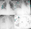 Fever, cough, sputum production, and anorexia for 1 week in a 77-year-old woman with asthma, which was managed daily with a long-acting β-agonist salmeterol and corticosteroid inhaler, who presented to a SARS-CoV-2 screening clinic. The test results confirmed SARS-CoV-2 infection, and the patient was transferred to a containment zone at our hospital. A, Anteroposterior chest radiograph obtained 14 days after symptom onset shows bilateral ill-defined ground-glass opacity and consolidation (arrows). B, C, Anteroposterior chest radiograph, B, obtained 19 days after symptom onset shows an increase in the extent of consolidation (arrows) after the patient’s symptoms worsened. Despite the use of extracorporeal membrane oxygenation (ECMO) in the intensive care unit, diffuse consolidation continued to increase until 4 weeks after the admission period, as depicted on the anteroposterior radiograph in C. D, Axial chest CT image obtained 5 weeks after symptom onset shows diffuse consolidation with air bronchogram and pneumothorax (arrowheads), clinically indicating acute respiratory distress syndrome. The patient died that day owing to sepsis and multiorgan failure.