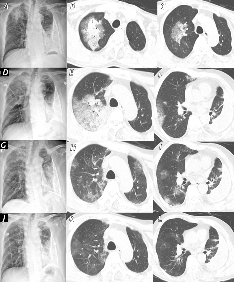 Fever and myalgia in a 61-year-old man with a history of chronic pleurisy 48 years earlier who presented to a SARS-CoV-2 screening clinic. He had attended a religious meeting where people with SARS-CoV-2 infection had been identified 14 days earlier. A, Initial PA chest radiograph (obtained 14 days after symptom onset) shows patchy consolidation in the right upper lung zone. B, C, Axial CT images obtained on the same day as the chest radiograph show patchy consolidation with surrounding ground-glass opacity in the central area of the right upper lobe. Note the calcified fibrothorax with chronic left pleural effusion in the left hemithorax. D–F, PA radiograph, D, and axial CT images, E, F, show that the extent of consolidation and ground-glass opacity increased over 3 days. After intensive conservative care, symptoms were relieved, and the extent of consolidation gradually decreased. G–I, Follow-up PA radiograph, G, and axial CT images, H,I, obtained after 7 days (24 days from symptom onset) show residual multifocal ground-glass opacity in both lungs. J–L, PA chest radiograph, J, and axial CT images, K, L, obtained before patient discharge (30 days from symptom onset) show almost complete resolution of ground-glass opacities in both lungs.