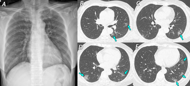 Mild cough and dizziness 1 day before visiting a screening clinic in a 62-year-old woman with contact history with a confirmed SARS-CoV-2–infected patient 4 days earlier. RT-PCR test results were positive for SARS-CoV-2, and she was transferred to our hospital and admitted to a containment zone. Initial chest CT findings (not shown) were normal. A, Posteroanterior (PA) chest radiograph obtained 9 days after initial symptom onset shows no definite abnormality. B–E, Follow-up axial chest CT images obtained on the same day as the chest radiograph show multifocal ground-glass opacities (arrows), predominantly located in the peripheral areas of both lungs. After 13 days of conservative management, her respiratory symptoms ameliorated, and a negative RT-PCR test result for SARS-CoV-2 was obtained. RT-PCR was repeated twice to confirm this negative result.