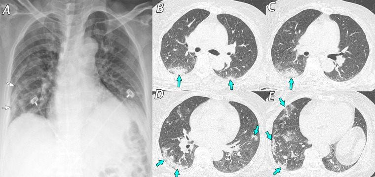 Mild cough and hemoptysis in a 64-year-old woman who was a caregiver in a hospital where SARS-CoV-2–infected patients were present. She underwent a screening test for SARS-CoV-2, and RT-PCR test results were positive. A, Anteroposterior supine chest radiograph obtained 7 days after symptom onset shows ill-defined consolidation (arrows) in the peripheral areas of the right middle to lower lung zones. B–E, Axial chest CT images obtained on the same day as the chest radiograph show irregular consolidation, with fine reticulation (arrows) in the peripheral subpleural areas of both the middle to lower lung zones, mainly in the right lung. She recovered within 14 days with conservative management and was discharged uneventfully after a negative RT-PCR test result.