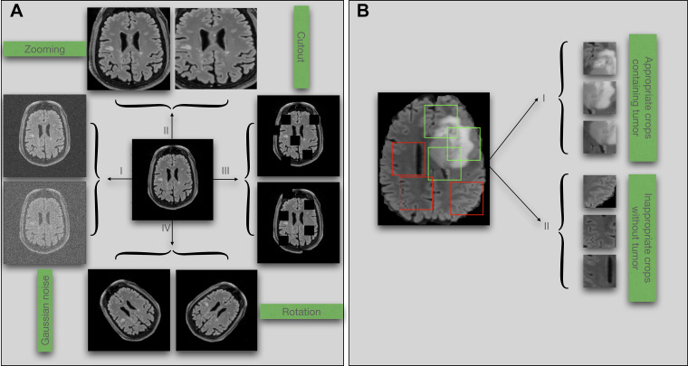 (A) Examples of data augmentation techniques: (I) adding noise, (II) zooming, (III) cutout, and (IV) rotation. (B) Illustration of potential bias associated with random cropping in classification tasks. Green boxes denote accurate crops, and red boxes denote inaccurate crops.