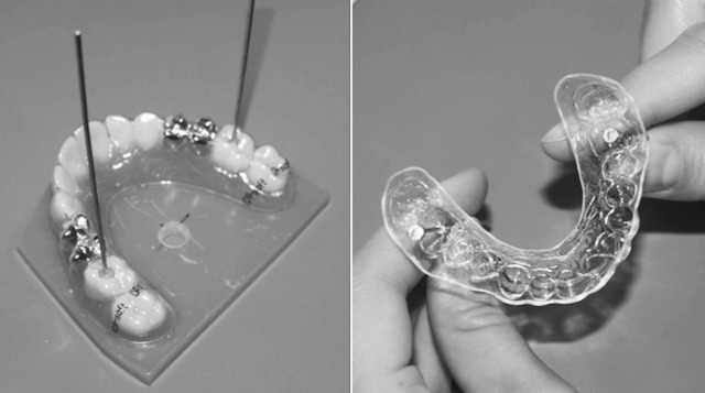 Figure 4. Reproducible locations of holes on the model base (6 mm in diameter) and the occlusal surfaces (3 mm in diameter and 5 mm in depth) of the first molars. The central mounting hole was used for fixation of the model in the Gabo Qualimeter Eplexor (GQE). The location was determined with one median line through the location of the palatal raphe intersecting with a line through the mesiolingual cusps of the first molars. The molar holes provided room for the stops of two steel ropes that passed through the aligner into the bolting apparatus on the GQE.