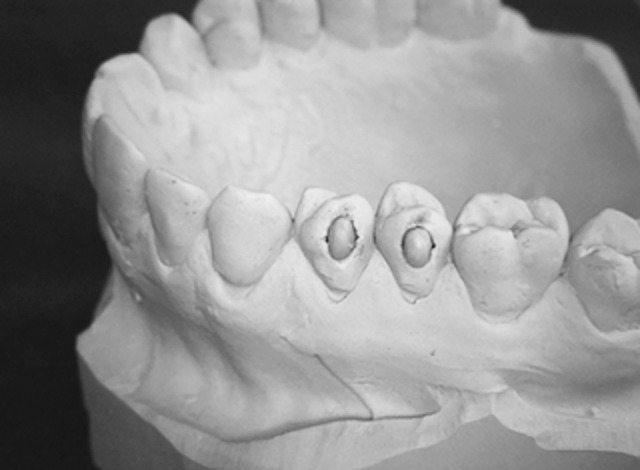 Figure 1. Stone model with ellipsoid attachments, which were added to both premolars. Attachment shapes inspired by Invisalign attachments.