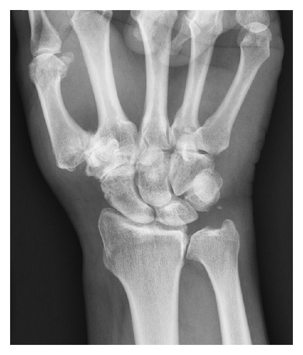 Osteoarthritis of the Wrist STT Joint and Radiocarpal Joint - PMC