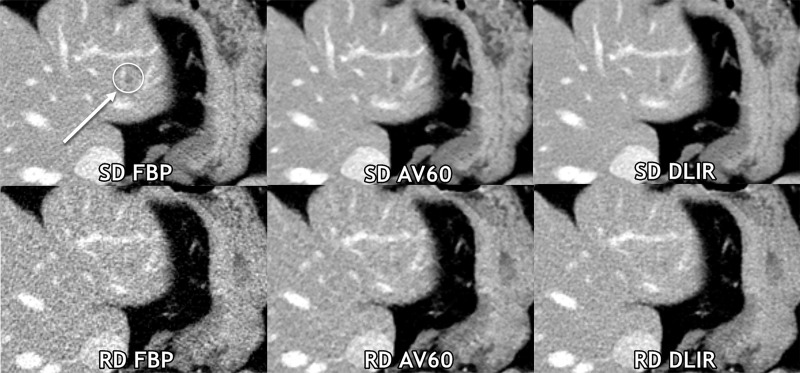 Axial contrast-enhanced CT images of the abdomen obtained with standard-dose (SD) filtered back projection (FBP) and reduced-dose (RD) deep learning image reconstruction (DLIR) with medium strength in the same breath hold. A 0.5-cm low-contrast left liver metastasis (arrow with circle) was missed by all three readers at reduced-dose deep DLIR and was detected by all readers at standard-dose FBP. Of note, all three readers qualitatively scored this reduced-dose DLIR scan as a 4 (superior to standard-dose FBP scores of 3 by each reader), even at the aggressive radiation dose reduction of 67% on this scan. Contrast-to-noise ratios for liver metastases in this participant for standard-dose FBP, standard-dose ASIR-V 60% (AV60), standard-dose DLIR, reduced-dose FBP, reduced-dose AV60, and reduced-dose DLIR were 3.6, 4.6, 4.7, 2.1, 3.3, and 3.4, respectively.