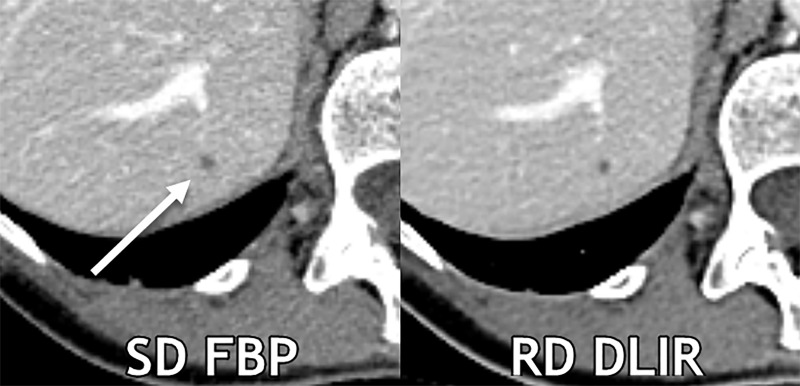 Axial contrast-enhanced CT images show a 0.3-cm liver cyst (arrow) that was detected by all readers on both scans. However, all three reader characterizations were false-positive at standard-dose (SD) filtered back projection (FBP), whereas the regular-dose (RD) deep learning image reconstruction (DLIR) with medium strength scan resulted in two true-negative characterizations and one false-positive characterization. At a radiation dose reduction of 66% on this scan, the cyst appears more conspicuous with DLIR, and each reader qualitatively scored the reduced-dose DLIR scan to be better than or equivalent to the standard-dose FBP scan. Contrast-to-noise ratios for liver metastases in this participant for standard-dose FBP and reduced-dose DLIR were 3.9 and 4.6, respectively.