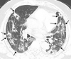 The noncontrast thin-section chest CT in a 53-year-old man with fever and confirmed with COVID-19. The CT image shows pleuroparenchymal interface irregularity (black arrows) and consolidation (asterisks).