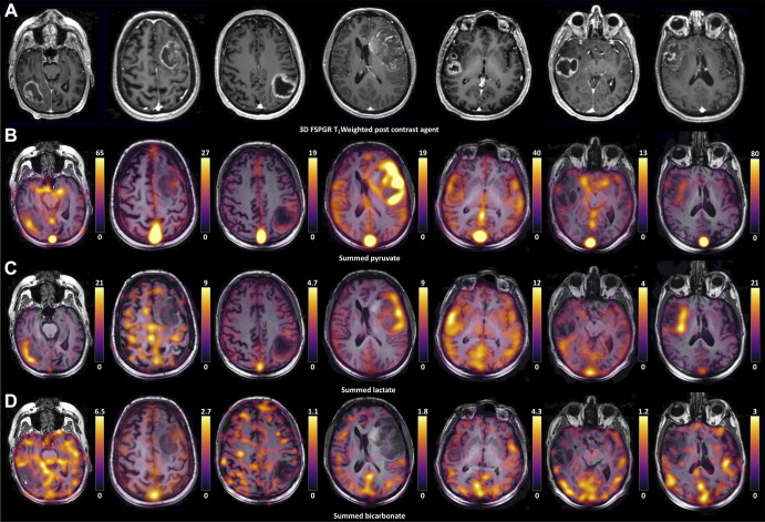 Hyperpolarized 13C MR images from all seven patients. (A) Grayscale axial contrast-enhanced 1H three-dimensional (3D) T1-weighted fast spoiled gradient-echo (FSPGR) images through the center of the lesion for each patient and the corresponding unenhanced images overlaid with the (B) pyruvate, (C) lactate, and (D) bicarbonate color maps summed over the time course.