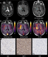 (A–C) Proton images, hyperpolarized 13C MR images, and
immunohistochemical (IHC) data from participant 7 (74-year-old man with
glioblastoma). (A) Grayscale axial three-dimensional (3D) T2-weighted (T2W),
fluid-attenuated inversion recovery (FLAIR), and gadolinium-based contrast
agent (GBCA)–enhanced 3D T1-weighted (T1W) fast spoiled gradient-echo
images through the center of the lesion. There is a lesion within the right
anterior temporal lobe demonstrating T2-weighted and FLAIR hyperintensity
involving the right insula and external capsule and reaching the lentiform
nucleus. (B) The corresponding pyruvate and lactate maps summed over the
entire time course and the lactate-to-pyruvate (LP) ratio map are shown in
color superimposed on the T1-weighted images before contrast enhancement.
The metabolic maps reveal heterogeneity, with higher pyruvate and lactate
being shown in the medial aspect of the lesion; the LP ratio was
particularly higher in the posterior part of insula. (C) Representative IHC
imaging, shown with a 20× magnification, from the target region of
interest highlighted on the 1H and 13C MR images (blue circle) stained for
ki-67, monocarboxylate transporter 1 (MCT1), and carbonic anhydrase IX
(CAIX). Details on IHC analysis are provided in Appendix E1 (supplement); in
brief, the antibodies used for staining were: M7240 for ki-67, HPA003324 for
MCT1, and NCL-L-CAIX for CAIX. Histopathologic findings demonstrated a
homogeneous high-grade tumor with MIB-1 staining of approximately 8%, high
MCT-1 staining, and no significant staining for CAIX.