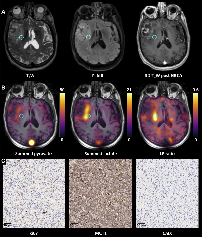 (A–C) Proton images, hyperpolarized 13C MR images, and immunohistochemical (IHC) data from participant 7 (74-year-old man with glioblastoma). (A) Grayscale axial three-dimensional (3D) T2-weighted (T2W), fluid-attenuated inversion recovery (FLAIR), and gadolinium-based contrast agent (GBCA)–enhanced 3D T1-weighted (T1W) fast spoiled gradient-echo images through the center of the lesion. There is a lesion within the right anterior temporal lobe demonstrating T2-weighted and FLAIR hyperintensity involving the right insula and external capsule and reaching the lentiform nucleus. (B) The corresponding pyruvate and lactate maps summed over the entire time course and the lactate-to-pyruvate (LP) ratio map are shown in color superimposed on the T1-weighted images before contrast enhancement. The metabolic maps reveal heterogeneity, with higher pyruvate and lactate being shown in the medial aspect of the lesion; the LP ratio was particularly higher in the posterior part of insula. (C) Representative IHC imaging, shown with a 20× magnification, from the target region of interest highlighted on the 1H and 13C MR images (blue circle) stained for ki-67, monocarboxylate transporter 1 (MCT1), and carbonic anhydrase IX (CAIX). Details on IHC analysis are provided in Appendix E1 (supplement); in brief, the antibodies used for staining were: M7240 for ki-67, HPA003324 for MCT1, and NCL-L-CAIX for CAIX. Histopathologic findings demonstrated a homogeneous high-grade tumor with MIB-1 staining of approximately 8%, high MCT-1 staining, and no significant staining for CAIX.