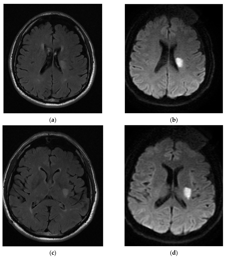 Acute anterior choroidal artery territory infarction a case series