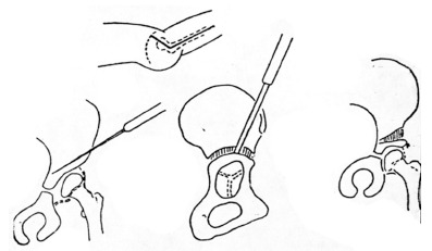 Dega pelvic osteotomy: indications, results and complications - PMC