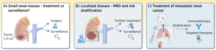 Figure 1. Clinical challenges in renal cancer management. Listing some of the major challenges within patients with renal cancer management. A, For small renal masses, the dilemma is between operating or taking a watchful waiting strategy. B, For localized disease, risk stratification is needed. Does the patient need further treatment after curatively intended surgery? C, For metastatic disease, which treatment to offer is the main challenge. Immunotherapy should be administered only to patients most likely to respond to the treatment. (Adapted from an image created with BioRender.com.)