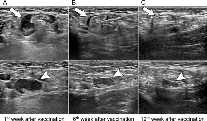 Images in a 43-year-old asymptomatic woman without breast cancer and unilateral left axillary adenopathy after messenger RNA COVID-19 vaccination. Axial US images of the left axilla show two enlarged lymph nodes (arrow, top; arrowhead, bottom). (A) US scan obtained within the 1st week of BNT162b2 vaccination shows the cortex measuring up to 7.7 mm (arrowhead). (B, C) Follow-up US images obtained within 6 weeks (B) and 12 weeks (C) show decreased axillary lymphadenopathy of variable degrees, with the cortex measuring up to 5.7 and 3.4 mm (arrowhead), respectively.