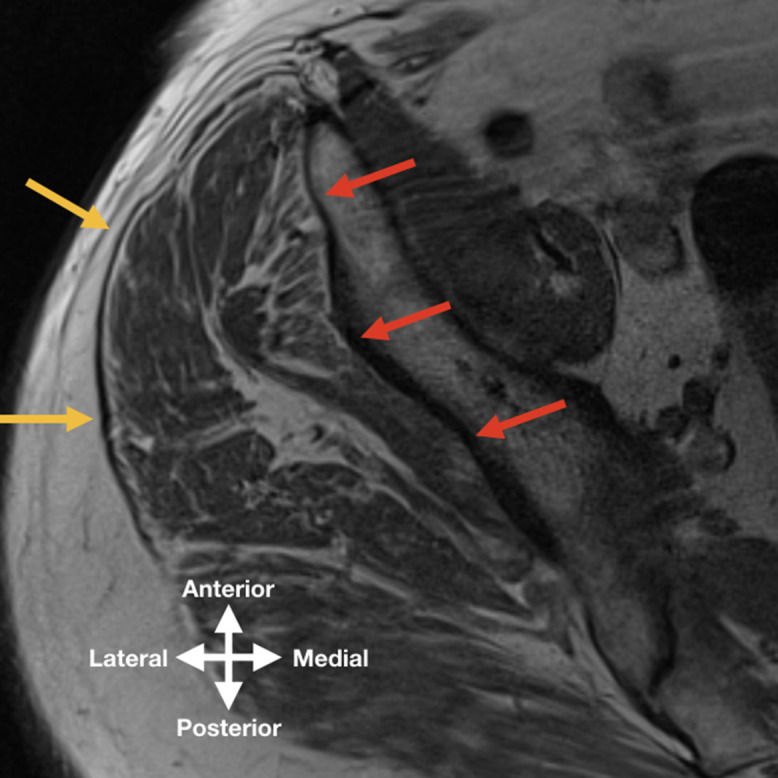 Gluteal atrophy and fatty infiltration in end-stage osteoarthritis of ...