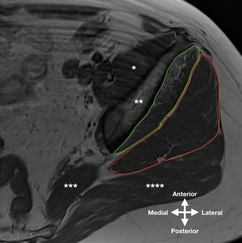 Gluteal atrophy and fatty infiltration in end-stage osteoarthritis of ...