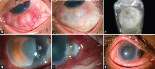 Scleritis: Differentiating infectious from non-infectious entities - PMC