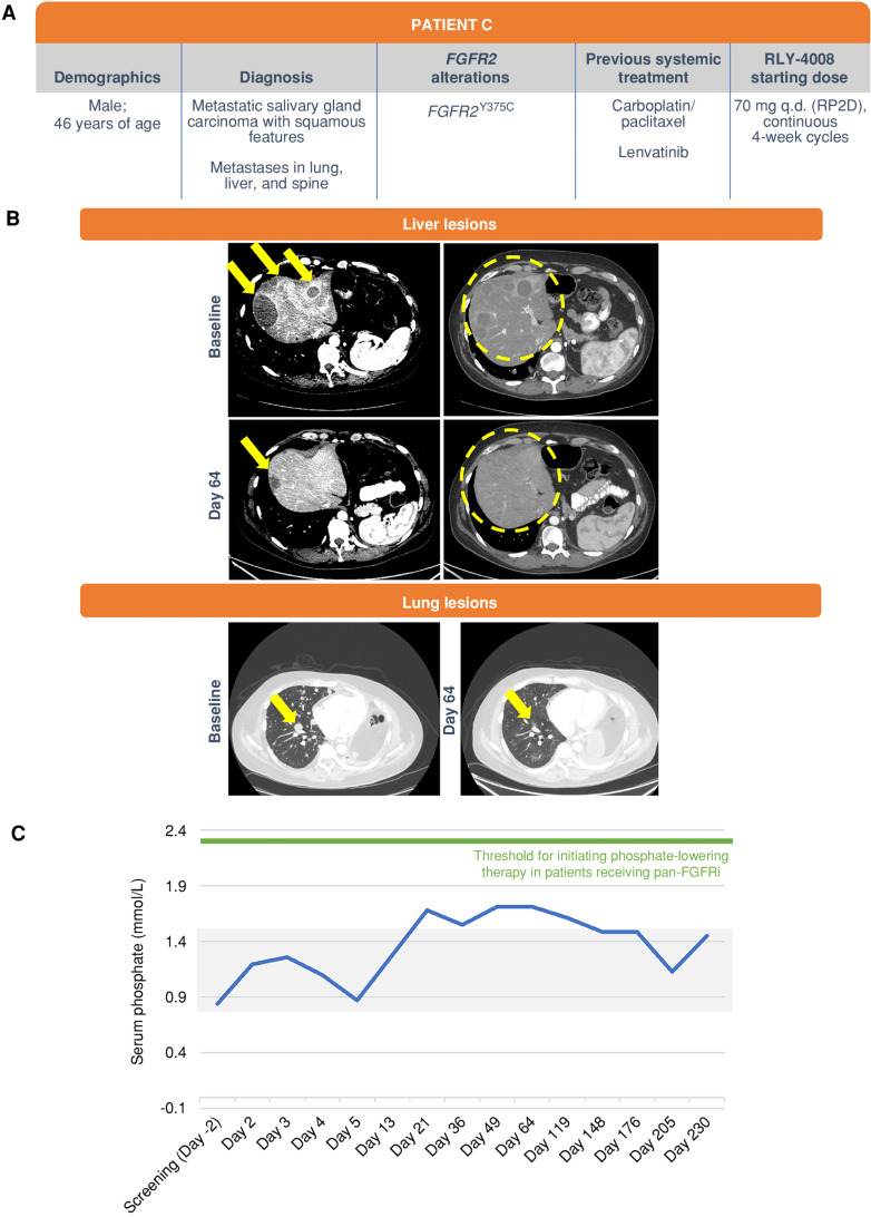 Figure 7. Clinical response in a patient with metastatic salivary gland carcinoma with squamous features and metastases in the lung, liver, and spine. The patient was treated with RLY-4008 at 70 mg once daily, the RP2D. A, Summary of key patient and disease characteristics. B, Liver lesions, left: CT scans of liver metastases on the dome at baseline (top; arrows) and day 64 of RLY-4008 treatment (bottom; arrow indicates remaining lesion with marked reduction in volume) show dramatic regression of lesions. Liver lesions, right: CT scans of diffuse metastatic lesions within the liver parenchyma at baseline and on day 64 of RLY-4008 treatment show a near complete regression of such lesions (circles). Lung lesions: CT scan of lung metastases at baseline and on day 64 of RLY-4008 treatment show overall decrease in lung metastases and near resolution of a lesion (arrow). C, Serum phosphate over the course of treatment with RLY-4008. The shaded area represents the normal range for serum phosphate (0.8–1.5 mmol/L). q.d., once daily; RP2D, recommended phase II dose.