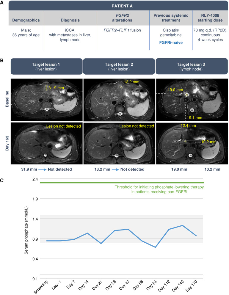 Figure 5. Clinical response in an FGFRi-naive iCCA patient with liver and lymph node metastases. The patient was treated with RLY-4008 at 70 mg once daily, the RP2D. A, Summary of key patient and disease characteristics. B, CT scans of liver and lymph node metastases at baseline (top) and after 163 days of RLY-4008 treatment (bottom) show profound tumor regression. C, Serum phosphate over the course of treatment with RLY-4008. The shaded area represents the normal range for serum phosphate (0.8–1.5 mmol/L). q.d., once daily; RP2D, recommended phase II dose.