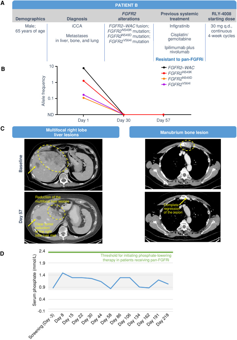 Figure 6. Clinical response in a patient with pan-FGFRi–resistant iCCA with liver, bone, and lung metastases. The patient was treated with RLY-4008 starting at 30 mg once daily. A, Summary of key patient and disease characteristics. B, ctDNA analysis demonstrated complete clearance of FGFR2N549K, FGFR2N549D, and FGFR2V564 L clones by day 30. C, Left: CT scans of right lobe liver metastasis (arrow) and multifocal liver lesions (circled) at baseline (top) and on day 57 of RLY-4008 treatment (bottom) show a rapid, marked reduction in tumor volume. Right: CT scans of manubrium bone lesion at baseline (top) and on day 57 of RLY-4008 treatment (bottom) show complete regression of lesion. D, Serum phosphate during treatment with RLY-4008. Shaded area represents the normal range for serum phosphate (0.8–1.5 mmol/L). ND, not detectable; q.d., once daily.