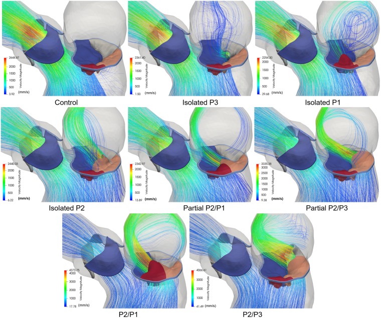 New insights into mitral heart valve prolapse after chordae rupture ...