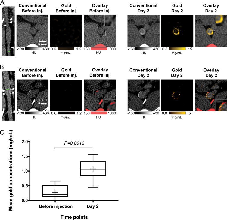 Photon-counting CT images of atherosclerotic rabbit aortas before and 2 days after injection (inj.) of gold nanoparticles. A, Images show noncalcified plaque with strong circumferential enhancement and mean wall concentration of 4.5 mg/mL of gold nanoparticles. Parietal calcifications (arrowheads) are also shown. Green line in first image indicates aortic section analyzed. Rectangles in Overlay Before inj. and Overlay Day 2 images represent close-up view of parietal wall for better analyzing enhancement. B, Images show calcified plaque with strong enhancement within and around calcified area and mean wall concentration of 2.74 mg/mL of gold nanoparticles. Parietal calcifications (arrowheads) are also shown. Green line in first image indicates aortic section analyzed. Spotty areas of enhancement were more discernable on gold k-edge image than on conventional image. Rectangles in Overlay Before inj. and Overlay Day 2 images represent a close-up view of parietal wall for better analyzing enhancement. C, Box-and-whisker plot shows quantitative analysis of mean gold concentration found in whole atherosclerotic rabbit abdominal aortic wall before injection (mean concentration, 0.28 mg/mL ± 0.22; range, 0.01–0.66 mg/mL) and 2 days after injection (mean, 1.07 mg/mL ± 0.36; range, 0.45–1.56 mg/mL). Lower and upper margins of each box indicate 25th and 75th percentiles. Cross represents mean, and line in box represents median. Outliers indicate minimal and maximal values.