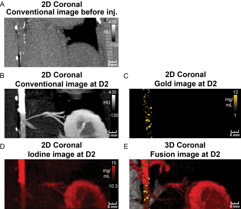 Photon-counting CT images of atherosclerotic rabbit aorta before and 2 days after injection (inj.) of gold nanoparticles. A, Coronal 5-mm-width maximum intensity projection conventional image before injection shows presence of focal hyperattenuation along aortic wall indicative of calcifications. B–D, Coronal 5-mm-width maximum intensity projection aortic CT angiograms of atherosclerotic rabbit injected with vascular contrast material (iomerprol, 400 mg/mL) at 2 days (D2) after injection of gold nanoparticles. Lumens of aortic and renal arteries and enhancement of kidney and dense wall lesions are apparent on, B, maximum intensity projection conventional and, D, iodine images. C, Coronal 5-mm-width maximum intensity projection gold k-edge image shows extensive heterogeneous enhancement of wall. E, Fusion of three-dimensional (3D) volume rendering of conventional images with gold k-edge and iodine images shows spatial distribution of atherosclerotic macrophage burden within aortic wall. 2D = two-dimensional.