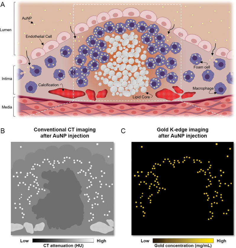 Molecular k-edge imaging approach using photon-counting CT in vivo for macrophage detection and quantification in calcified atherosclerotic plaque in combination with k-edge contrast material of gold nanoparticles (AuNP). A, Schematic of uptake of gold nanoparticles by macrophages within atherosclerotic plaque (gold nanoparticles are shown as yellow dots, macrophages and foam cells are shown in purple, lipid core is shown in white, and calcification is shown in red). Gray nodules in foam cells are lipid droplets. White dashed lines indicate field of view of close-up in B and C. B, Schematic of conventional CT image shows different high-attenuation materials (gold nanoparticles and calcifications) that hamper characterization and quantification of macrophage burden. C, Schematic of PCCT gold k-edge image for specific, noninvasive macrophage burden imaging, which permits quantification of gold nanoparticles.