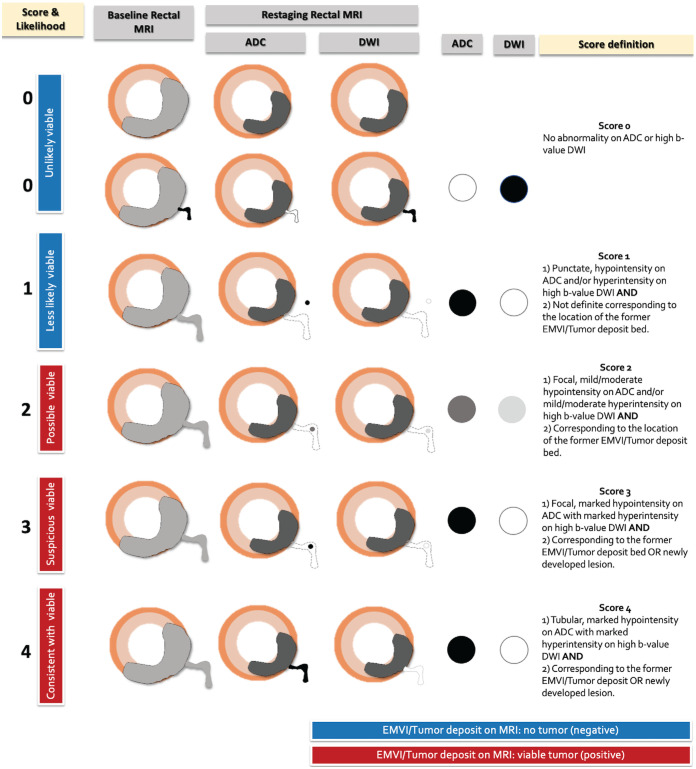 Diagram of the five-point Likert scale scoring system used to assess extramural venous invasion (EMVI) and tumor deposit on diffusion-weighted images with apparent diffusion coefficient (ADC) mapping. DWI = diffusion-weighted imaging.