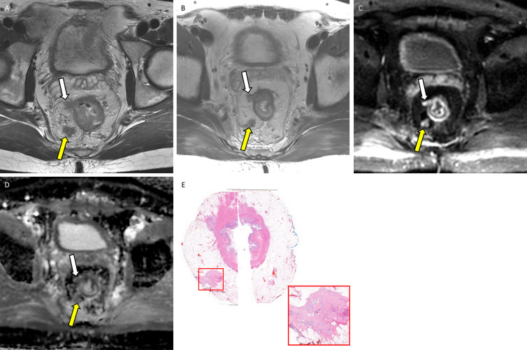 Example application of the diffusion-weighted (DW) image five-point Likert scale for assessing extramural venous invasion (EMVI) or tumor deposit on MRI scans with corresponding whole-mount pathology in a 36-year-old man with locally advanced rectal adenocarcinoma. (A) Baseline axial T2-weighted MRI scan shows EMVI and tumor deposit in the 6 to 9 o’clock quadrant (yellow arrow) and 9 to 12 o’clock quadrant (white arrow). (B) Postneoadjuvant therapy axial T2-weighted MRI scan shows partially regressed EMVI and tumor deposit in the 6 to 9 o’clock quadrant (yellow arrow) and 9–12 o’clock quadrant (white arrow). Postneoadjuvant therapy (C) axial DW image and (D) apparent diffusion coefficient map with a score of 4 (consistent with viable) in the 6 to 9 o’clock quadrant (yellow arrow) and in the 9 to 12 o’clock quadrant (white arrow). (E) Photomicrograph (hematoxylin-eosin stain, original magnification, ×2) shows viable tumor deposits corresponding to the 6 to 9 o’clock quadrant and 9 to 12 o’clock quadrant (red box; original magnification, ×50). Note that on A the lesion in the 9–12 o’clock quadrant presented similar to EMVI, contiguous from primary tumor bed; however, these turned out to be tumor deposits separate from primary tumor bed on E.