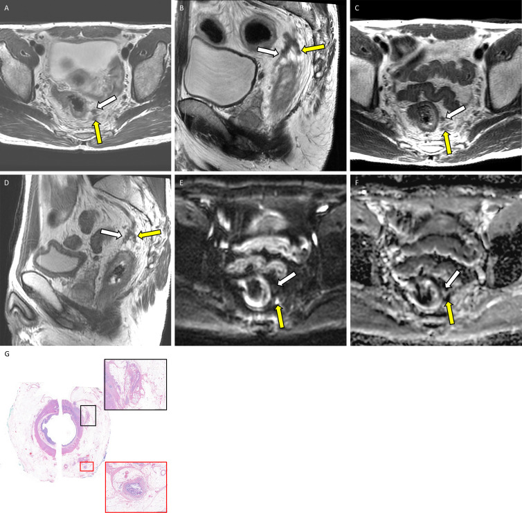 Example application of the diffusion-weighted (DW) image five-point Likert scale for assessing extramural venous invasion (EMVI) or tumor deposit at MRI with corresponding whole-mount pathology in a 46-year-old man with locally advanced rectal adenocarcinoma. Baseline (A) axial and (B) sagittal T2-weighted MRI scans show EMVI and tumor deposit in the 12 to 3 o’clock quadrant (white arrow) and in the 3 to 6 o’clock quadrant (yellow arrow). Postneoadjuvant (C) axial and (D) sagittal T2-weighted MRI scans show regressed EMVI and tumor deposit in both the 12 to 3 o’clock quadrant (white arrow) and the 3 to 6 o’clock quadrant (yellow arrow). Postneoadjuvant therapy (E) axial DW image and (F) apparent diffusion coefficient map yielded a score of 0 (unlikely viable) in the 12 to 3 o’clock quadrant (white arrow) and a score of 3 (suspicious viable) in the 3 to 6 o’clock quadrant (yellow arrow). (G) Photomicrograph (hematoxylin-eosin stain; original magnification, ×2) shows acellular mucin corresponding to the 12 to 3 o’clock quadrant, consistent with posttreatment change without viable malignant cells (black box; magnification, ×50). On the contrary, there is viable EMVI corresponding to the 3 to 6 o’clock quadrant (red box; magnification, ×50).