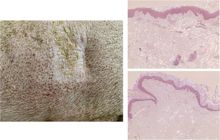 Figure 5. Left, A picture of 8 × 8–cm field 40 months post-FLASH treatment showing persistent but fibrotic contracture and depilation. Right, Hematoxylin and eosin (H&E) histologic staining of normal skin (top, ×10) with think stratum corneum, multilayer epidermis exhibiting many papilla, and dermal appendix (vessels, muscles, hair follicles) whereas the irradiated skin (bottom, ×10) exhibits thick stratum corneum, thin epidermis lacking papilla, and dermal appendix.