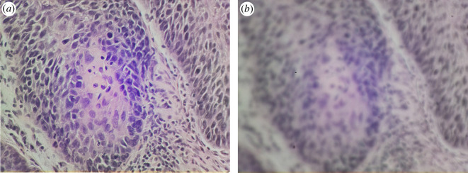 Images of a squamous cell carcinoma from a vocal cord sample, captured on the OpenFlexure Microscope with a 40 objective.