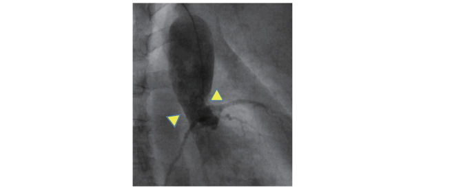 
Fig. 2.
Aortic Supra-valvular stenosis in HoFH
