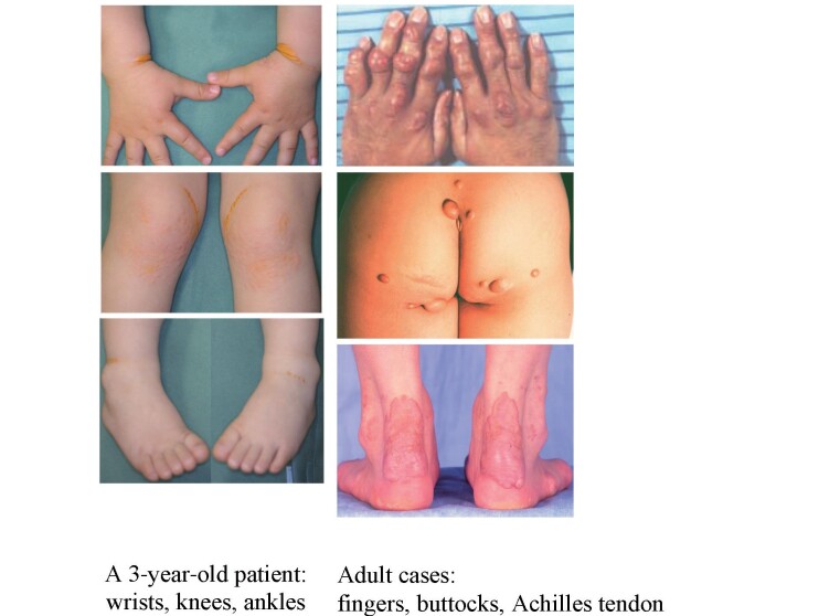 
Fig. 1.
Cutaneous and Tendon Xanthomas in HoFH
