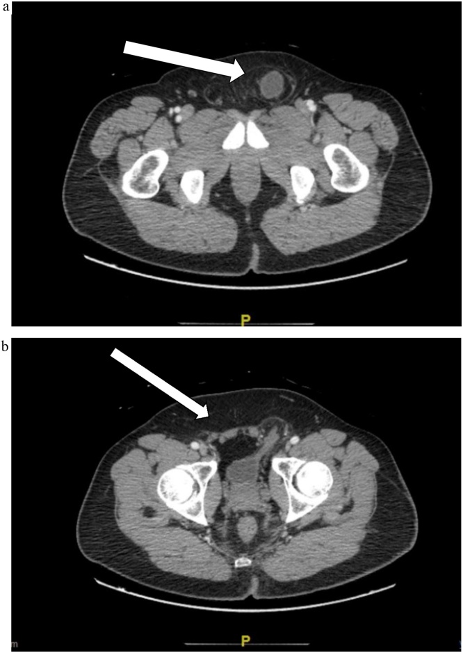 Inguinal bladder hernia: A case report and literature review - PMC