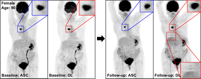 The potential benefits of PETDL are illustrated on baseline and 2-month follow-up PETASC and PETDL maximum intensity projection (MIP) scans in (a, b) patients with cancer and (c, d) adolescents who are at higher risk for radiation-induced damage. Note the overestimated tumor and streak artifacts on the DL-corrected images in a and the small blurred out low-uptake lesion on the DL-corrected images in b. Rotating MIP animations of PETASC and PETDL are shown in Figure E2 (supplement). Blue arrows indicate FDG findings with very low uptake that are not seen in PETDL.