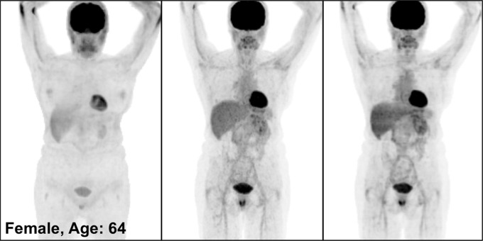 PETNC (left), PETASC (middle), and PETDL (right) maximum intensity projection (MIP) images in (a) a healthy patient, (b) a patient with widely metastatic cancer, (c) a patient with sparsely metastatic cancer, and (d) an obese patient demonstrate the overall quality of PETDL images. Rotating MIP animations of PETASC and PETDL are shown in Figure E1 (supplement).