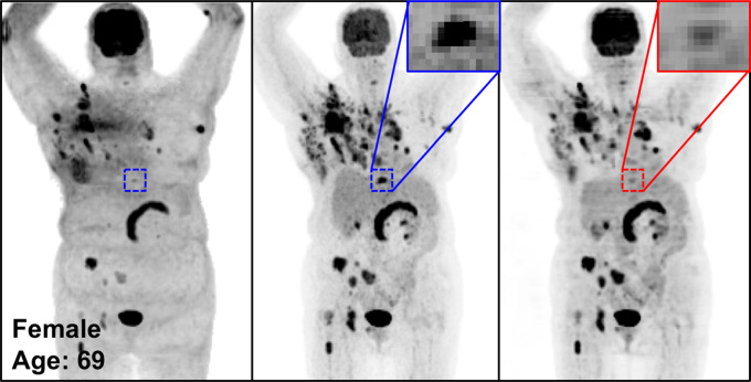 The potential pitfalls of PETDL are illustrated on noncorrected (left), attenuation- and scatter-corrected (middle), and deep learning–corrected (right) maximum intensity projection (MIP) PET images with (a) a missing one of two lesions in the chest (zoomed-in red box vs blue box), (b) an underestimated lesion in the spine, and (c, d) uncorrected pathologic structures in the chest (red vs blue dashed ellipse). A high-uptake lesion was missed in a and blurred in b, and the pathologic patterns were not corrected accurately on the PETDL images in b and c.