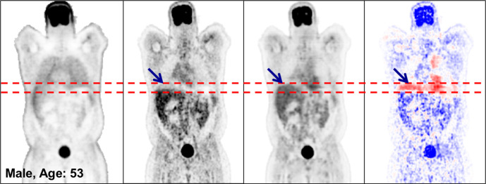 Coronal PETNC (far left column), PETASC (second from left column), PETDL (third from left column), and PETDL − PETASC (far right column) images illustrate the potential benefits of PETDL in (a) a patient with attenuation artifacts at the liver dome (blue arrows) and (b) a patient with washout artifacts near the bladder, who was excluded from the training set because of significant photopenic artifact. The pixel units on the difference images (far right) are standardized uptake values. Red dashed lines indicate range of the bladder. Blue and red coloration indicate under- and overestimated voxels in PETDL compared to the reference PETASC.