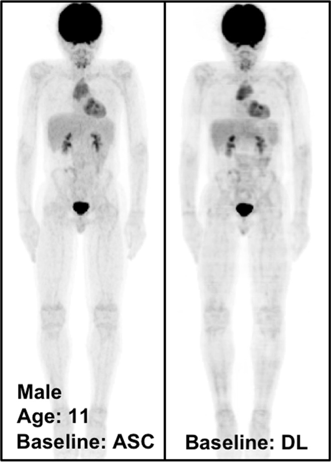 The potential benefits of PETDL are illustrated on baseline and 2-month follow-up PETASC and PETDL maximum intensity projection (MIP) scans in (a, b) patients with cancer and (c, d) adolescents who are at higher risk for radiation-induced damage. Note the overestimated tumor and streak artifacts on the DL-corrected images in a and the small blurred out low-uptake lesion on the DL-corrected images in b. Rotating MIP animations of PETASC and PETDL are shown in Figure E2 (supplement). Blue arrows indicate FDG findings with very low uptake that are not seen in PETDL.