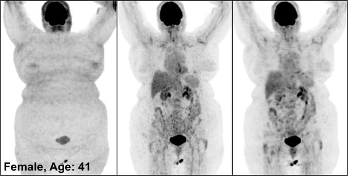 PETNC (left), PETASC (middle), and PETDL (right) maximum intensity projection (MIP) images in (a) a healthy patient, (b) a patient with widely metastatic cancer, (c) a patient with sparsely metastatic cancer, and (d) an obese patient demonstrate the overall quality of PETDL images. Rotating MIP animations of PETASC and PETDL are shown in Figure E1 (supplement).