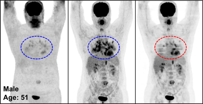 The potential pitfalls of PETDL are illustrated on noncorrected (left), attenuation- and scatter-corrected (middle), and deep learning–corrected (right) maximum intensity projection (MIP) PET images with (a) a missing one of two lesions in the chest (zoomed-in red box vs blue box), (b) an underestimated lesion in the spine, and (c, d) uncorrected pathologic structures in the chest (red vs blue dashed ellipse). A high-uptake lesion was missed in a and blurred in b, and the pathologic patterns were not corrected accurately on the PETDL images in b and c.